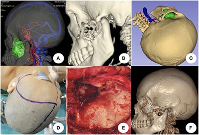 Surgical Effects of Resecting Skull Base Tumors Using Pre-operative Multimodal Image Fusion Technology: A Retrospective Study